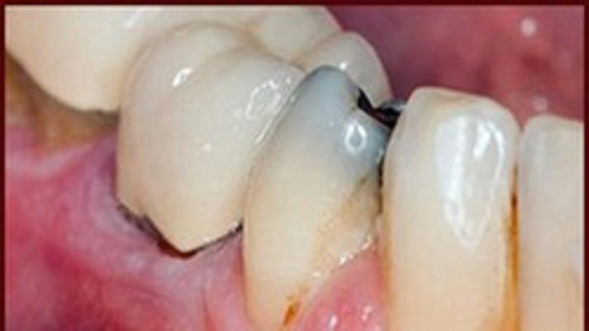 چگونه از دندان خود در مقابل کرونا محافظت کنیم؟