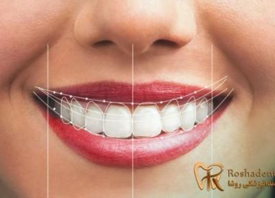 لیمنت دندان چیست ، قیمت لمینت دندان 1400 در تهران