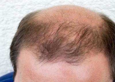 از ریزش موی سر چه میدانید؟