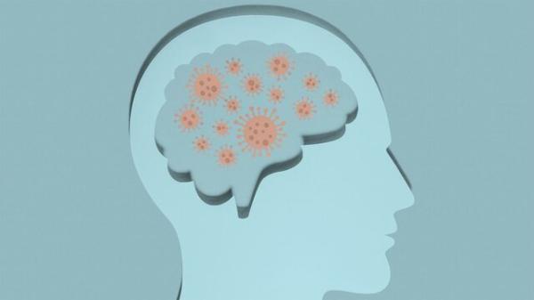 کدام فرد بهبودیافته از کرونا به آلزایمر مبتلا می شود؟