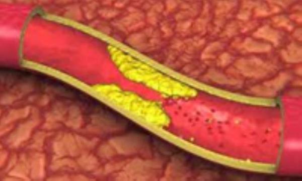 پیشگیری از تصلب شرایین پیشگیری از تصلب شرایین